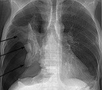 Tett oljepneumothorax – årsaker, symptomer og forebygging
